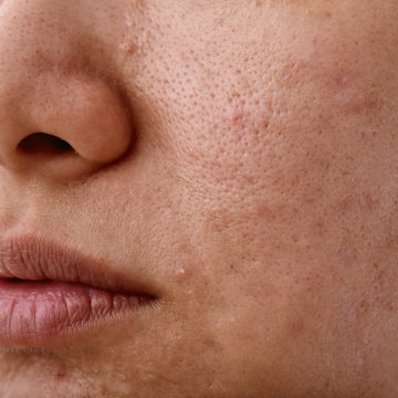 Could Your Bedsheets Be Making Your Skin Worse? What Dermatologists Want You To Know