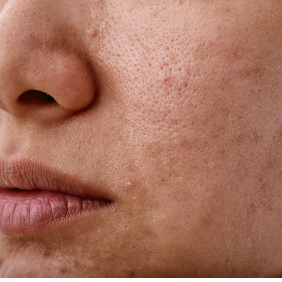 Are Polyester Bedsheets Aging Your Skin?