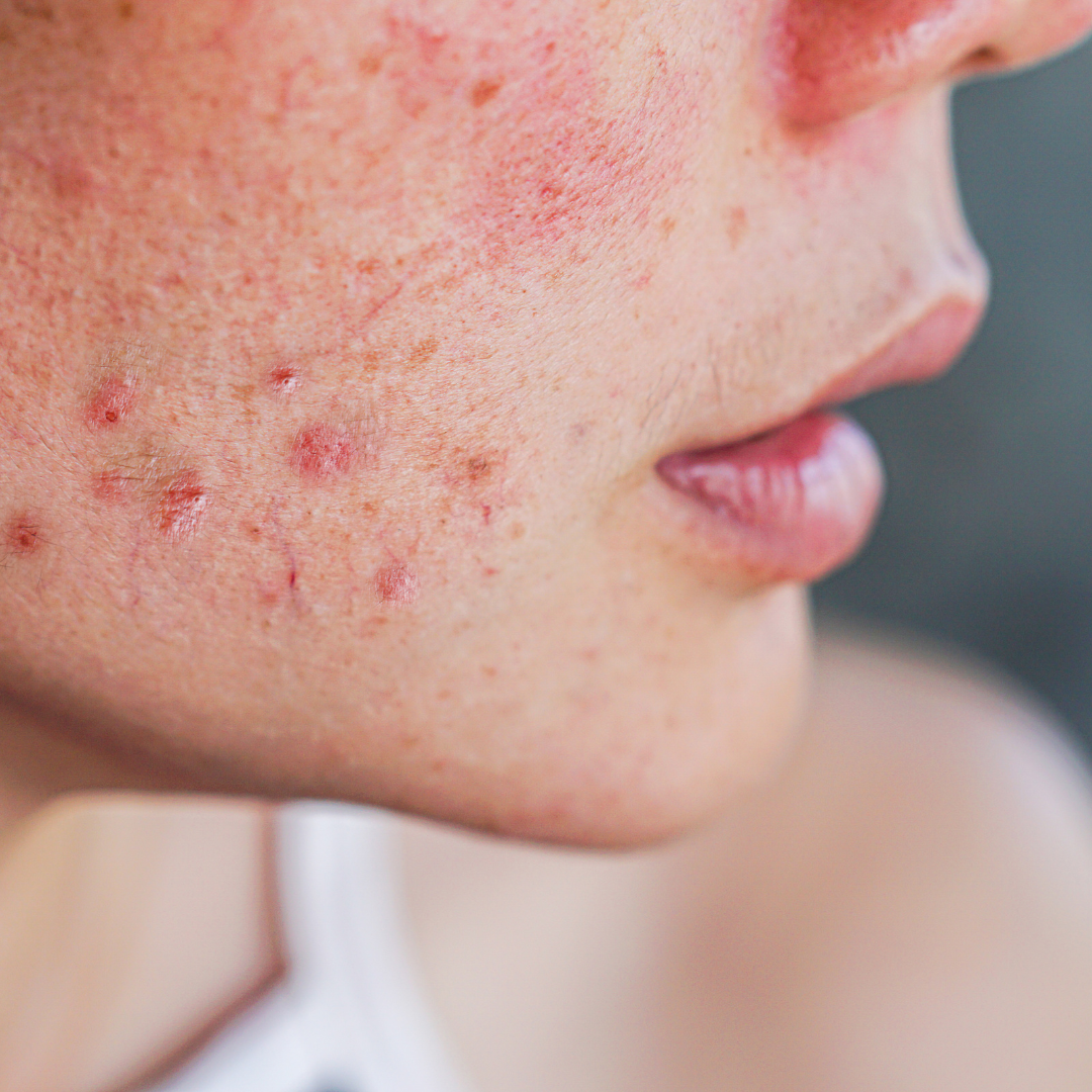 The Real Reason Your Bedding Is Triggering Acne (Hint: It’s Not Your Skincare)