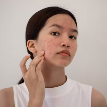 What Is the Best Bedsheet for Eczema in Malaysia and Singapore? (Dermatologist-Backed Guide)